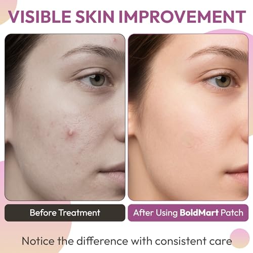 BoldMart Pimple Patches for Face – 36 Count Hydrocolloid Acne Patches, Invisible Blemish Patch, Waterproof Zit Stickers for Whiteheads, Overnight Spot Treatment, All Skin Types
