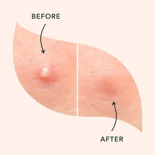 BoldMart Pimple Patches for Face – 36 Count Hydrocolloid Acne Patches, Invisible Blemish Patch, Waterproof Zit Stickers for Whiteheads, Overnight Spot Treatment, All Skin Types