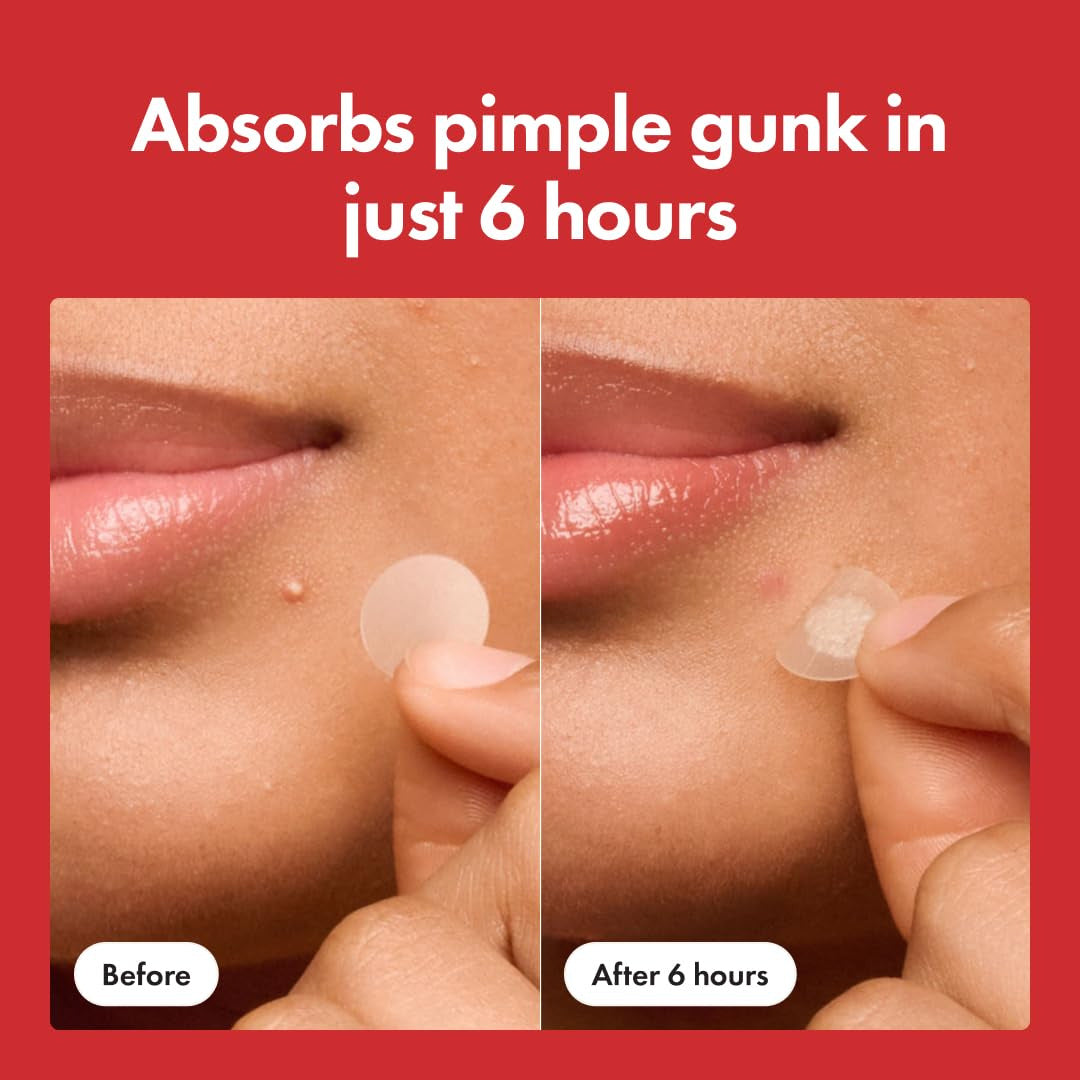 Hydrocolloid Pimple Patches – Acne Spot Treatment Stickers (36/72 Count)